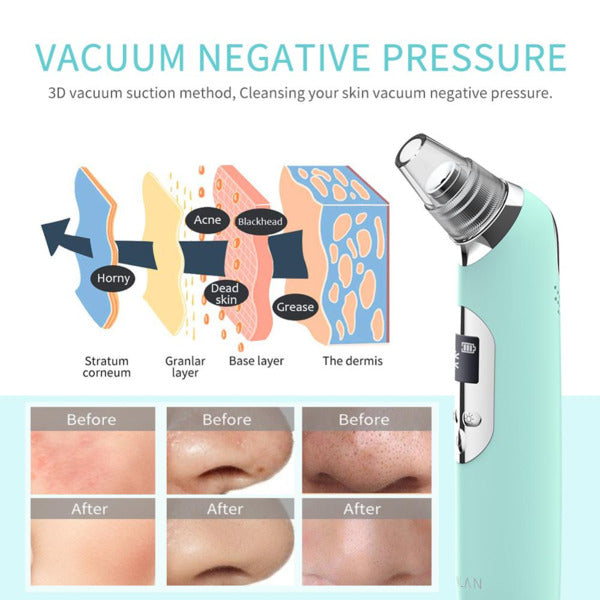 Hot Cold Blackhead Remover open the pores to clean and close the pores.